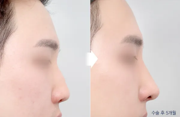 Before/After