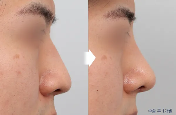 Before/After
