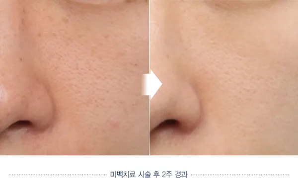 Before/After