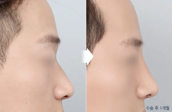 Before/After