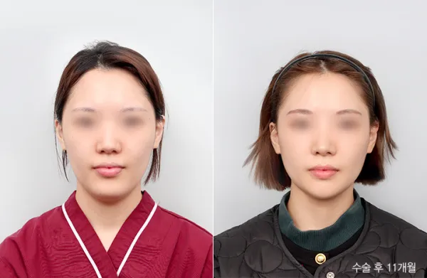 Before/After