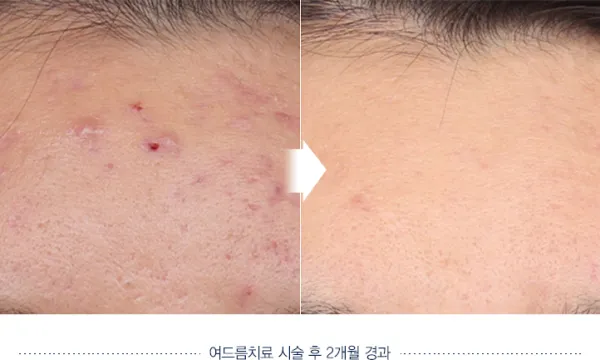 Before/After