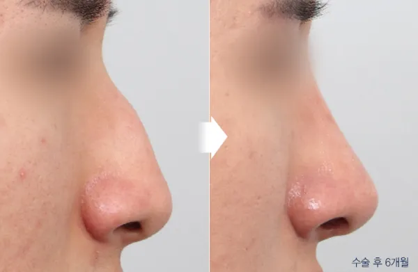 Before/After