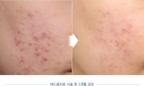 Before/After