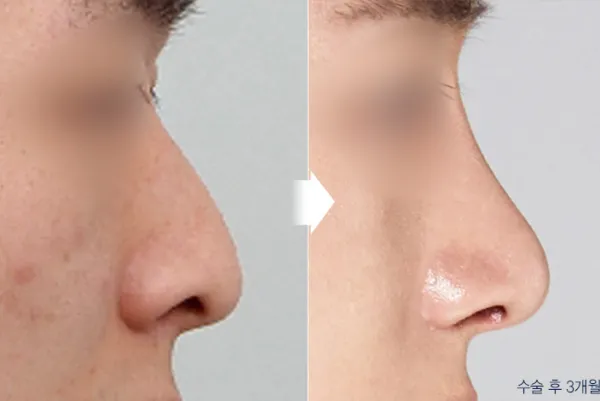 Before/After