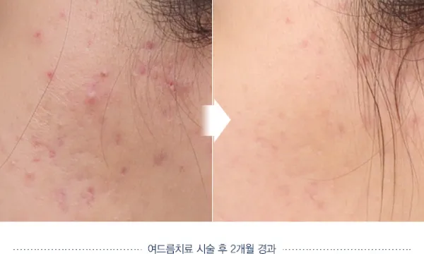Before/After