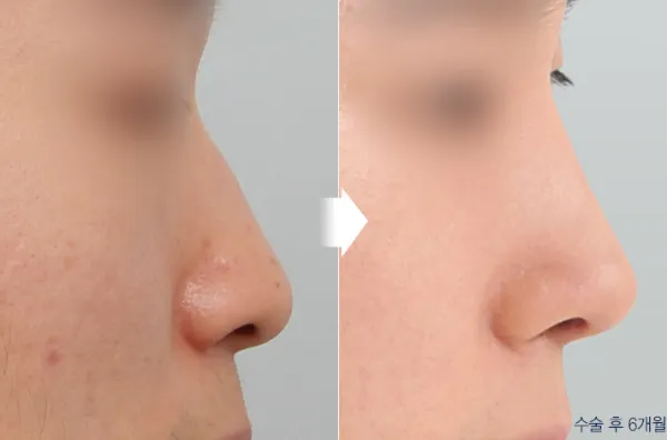 Before/After