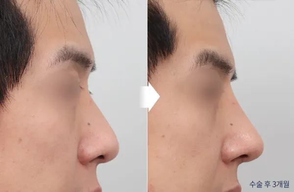 Before/After