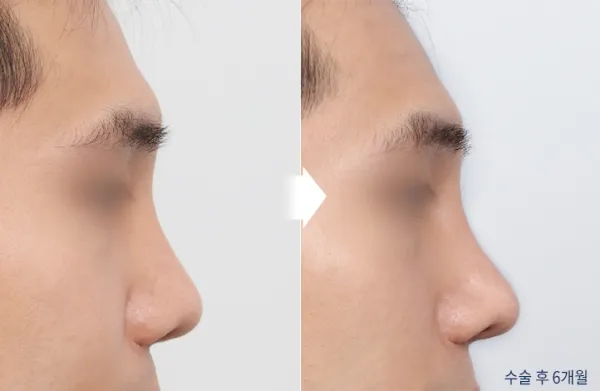 Before/After