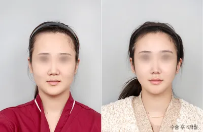 Before & After