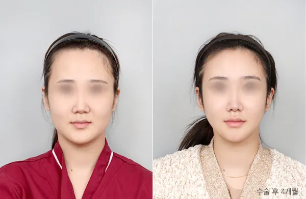 Before/After