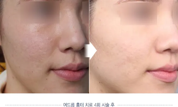 Before/After