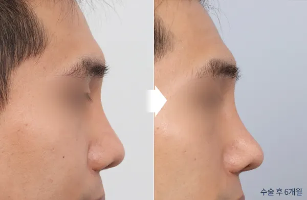 Before/After