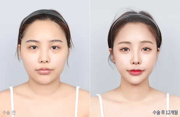 Before/After