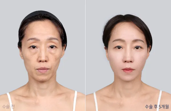 Before/After