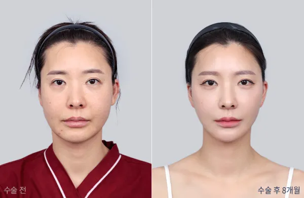 Before/After