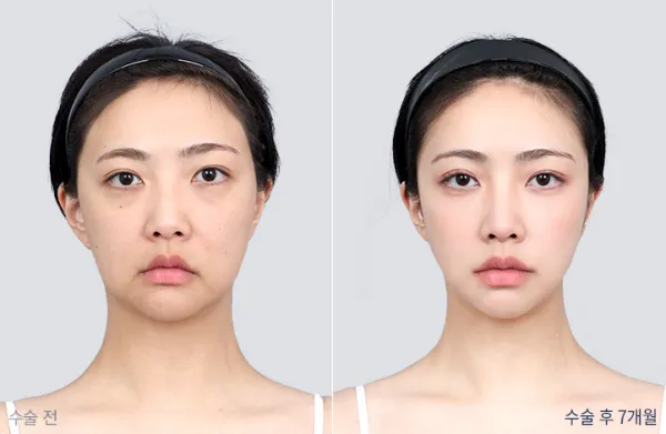 Before/After