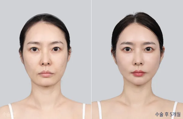 Before/After