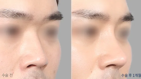 Before/After