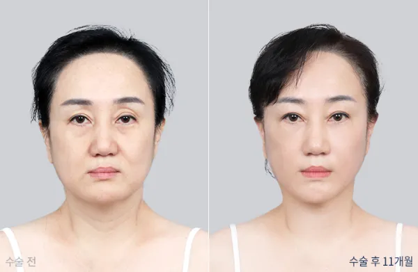 Before/After