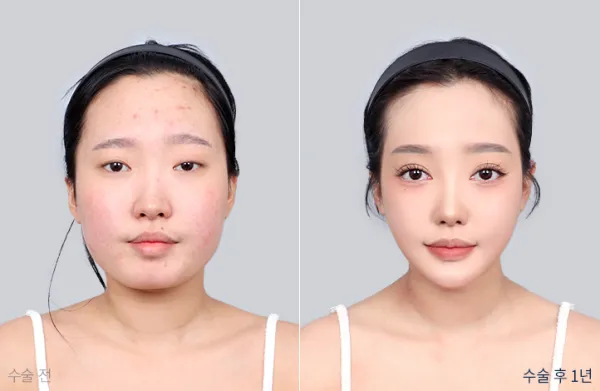 Before/After