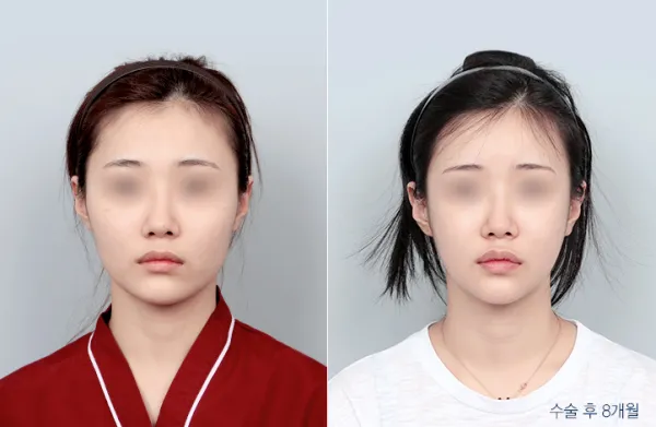 Before/After