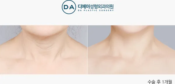 Before/After