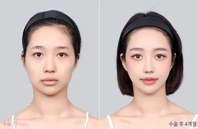 Before & After