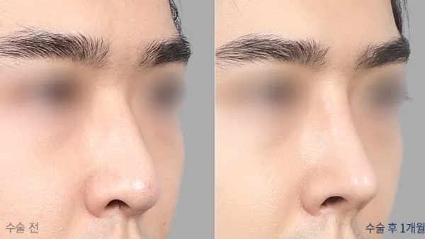 Before/After