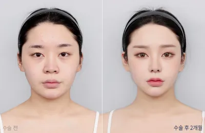 Before & After