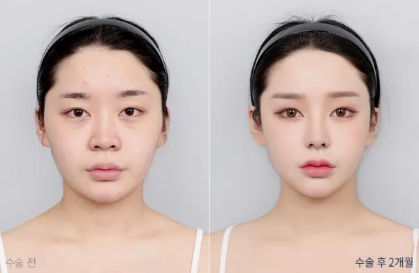 Before/After