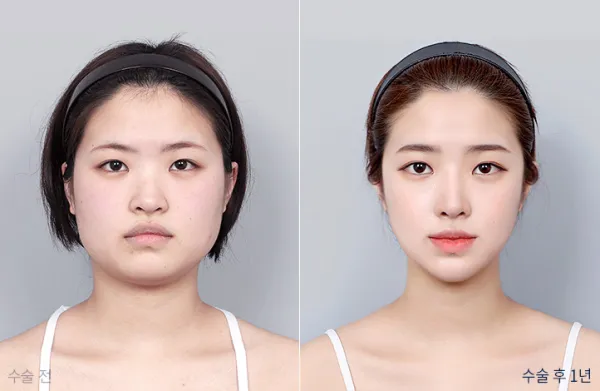 Before/After