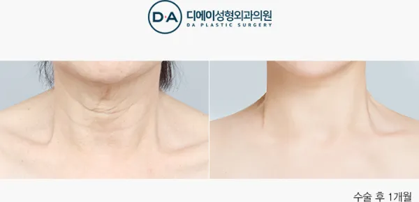 Before/After