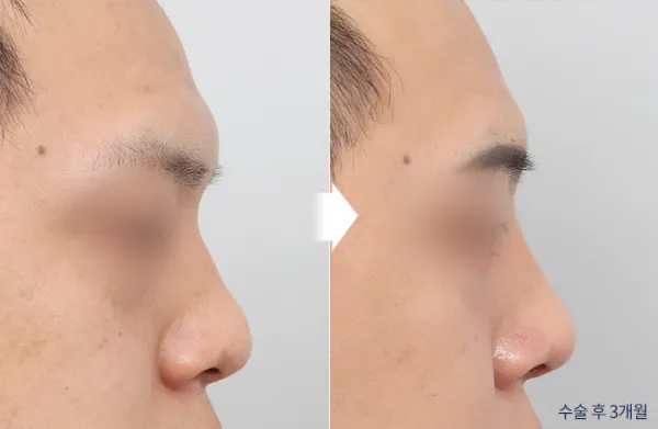 Before/After