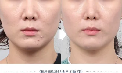 Before & After
