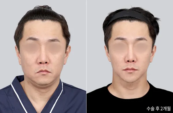 Before/After