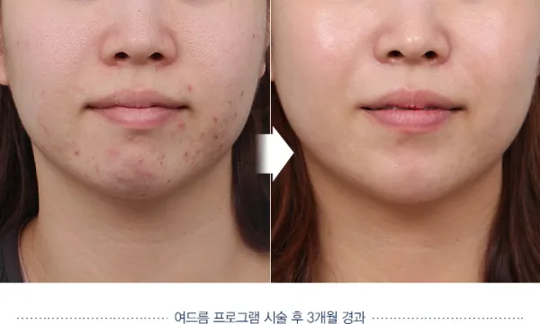 Before/After