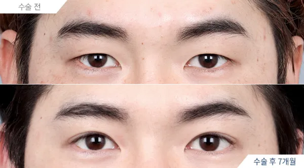 Before/After