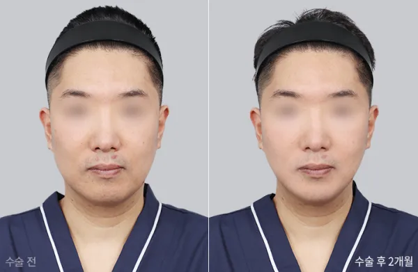Before/After