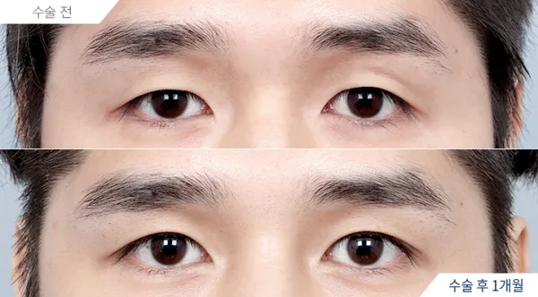 Before/After