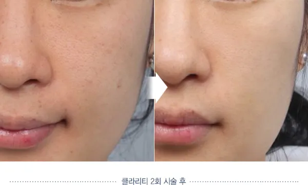 Before/After
