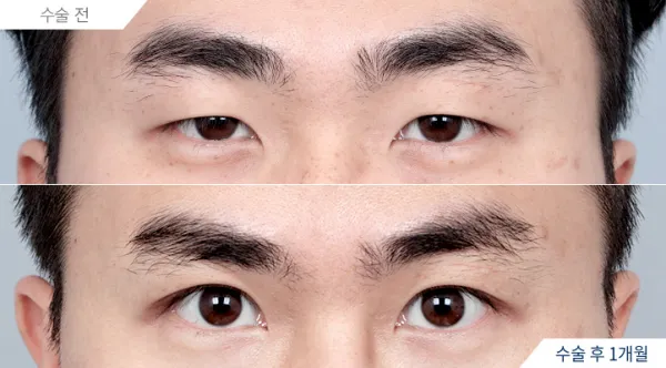 Before/After