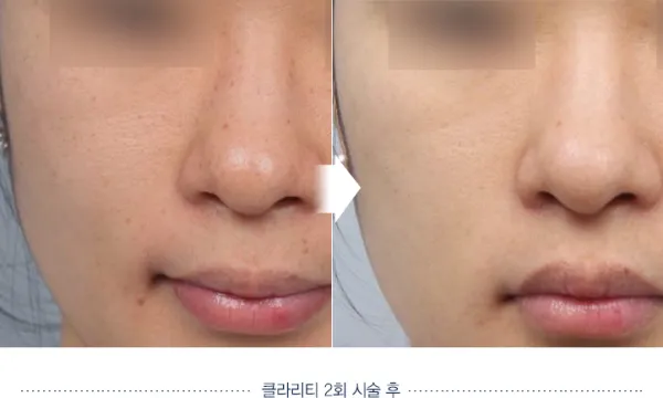 Before/After