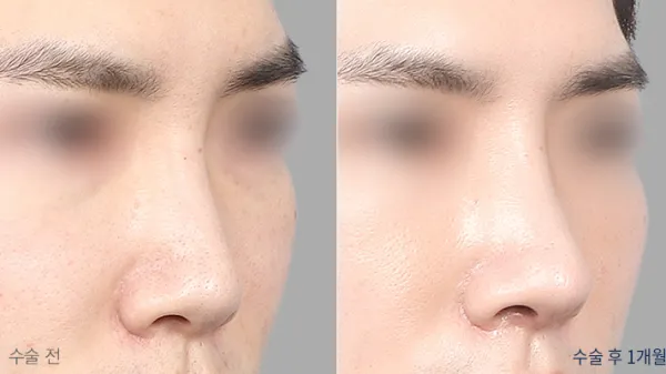 Before/After
