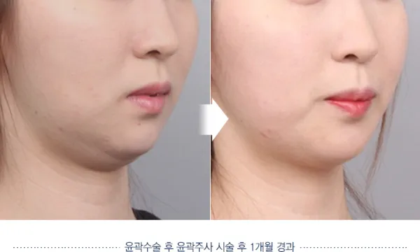 Before/After