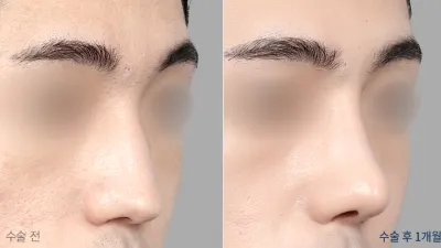Before & After