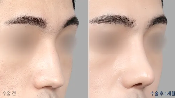 Before/After