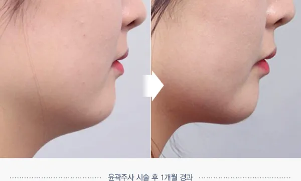 Before/After
