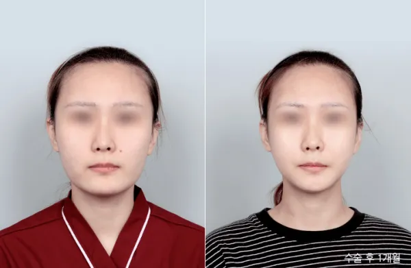 Before/After
