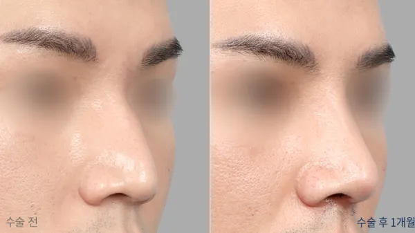 Before/After